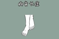 脚背上长痣代表什么