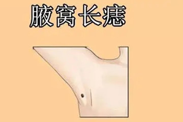 腋窝有痣好吗