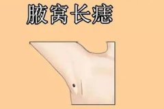 腋窝有痣好吗