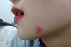 胎记长在哪个部位最好